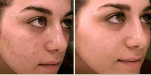 LIMPIEZA FACIAL TRATAMIENTO DEL ACNE